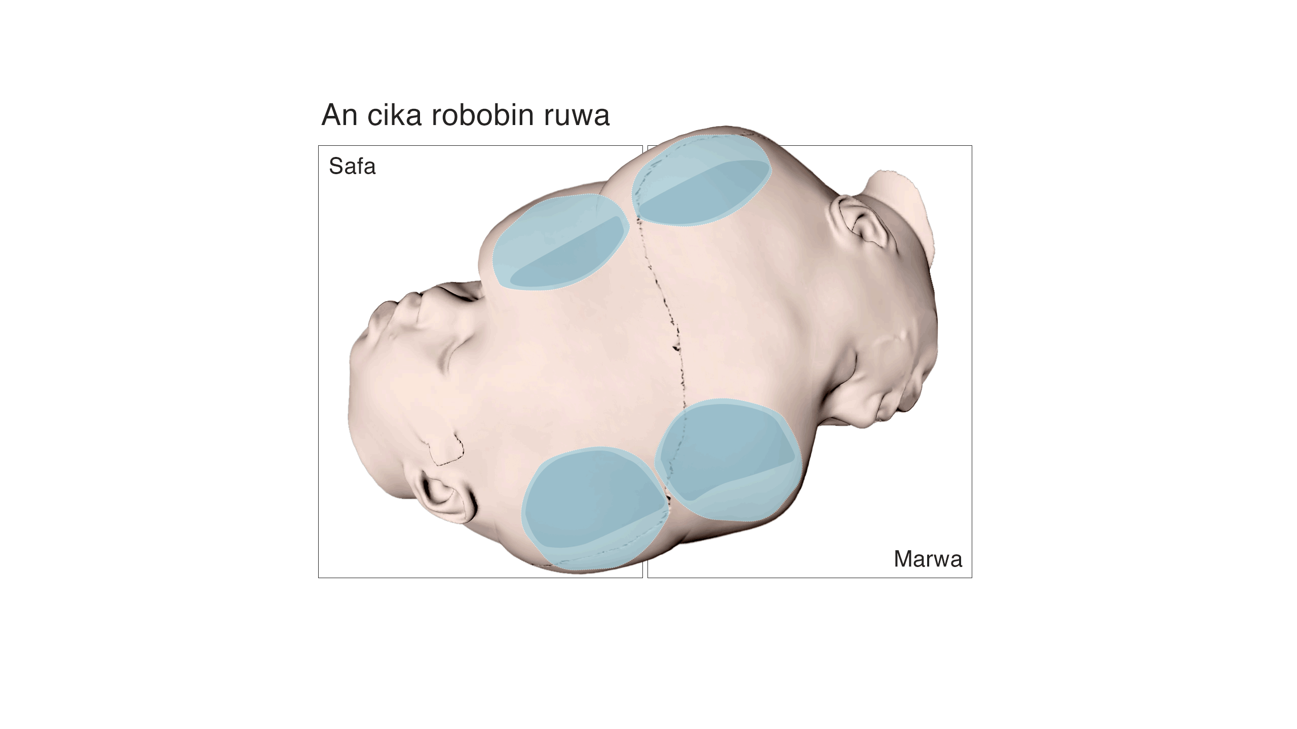 Sacks filled with saline