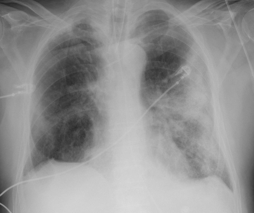 X-ray image of the lungs of a 68-year-old man with Coronavirus/Covid-19. The white areas at the edges of the lungs are inflammation of the air sacs, which is why patients find it hard to breathe. Source: The Royal College of Radiologists, UK
