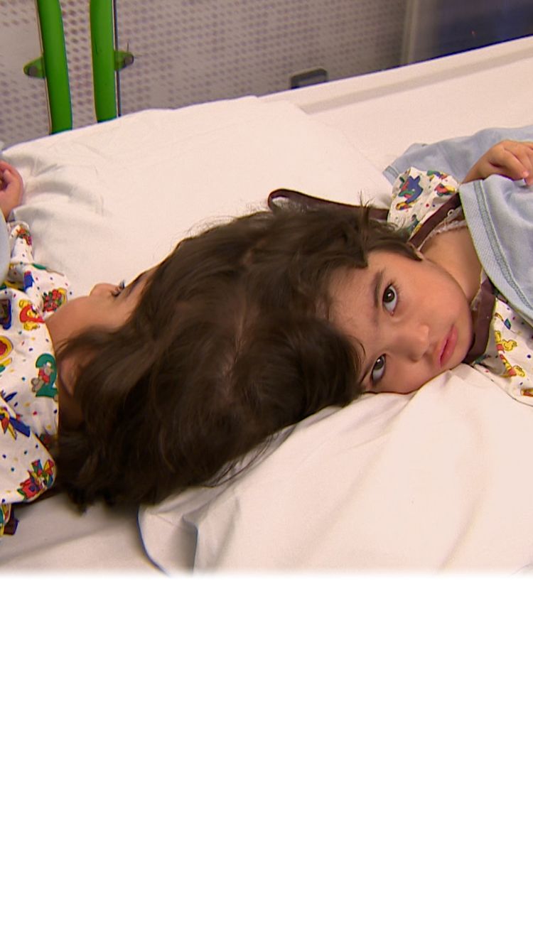 كيف جرت معجزة على أيدي الأطباء لفصل صفا عن مروة