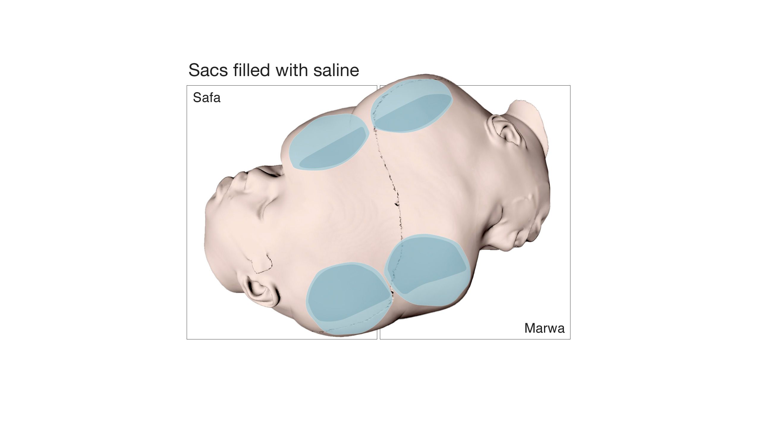 Sacks filled with saline