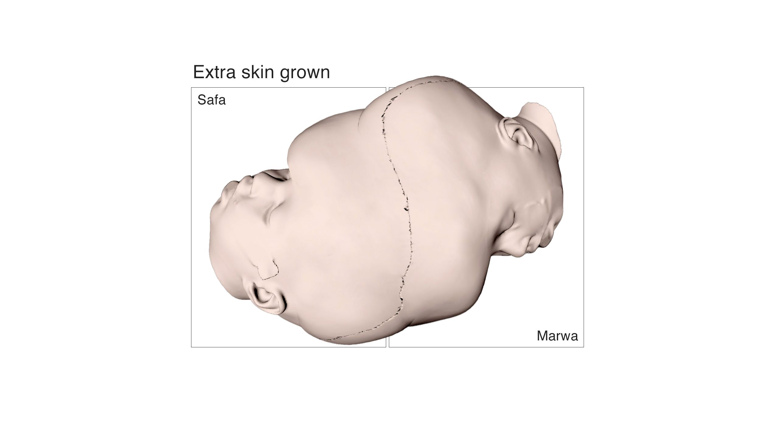 Extra skin growth