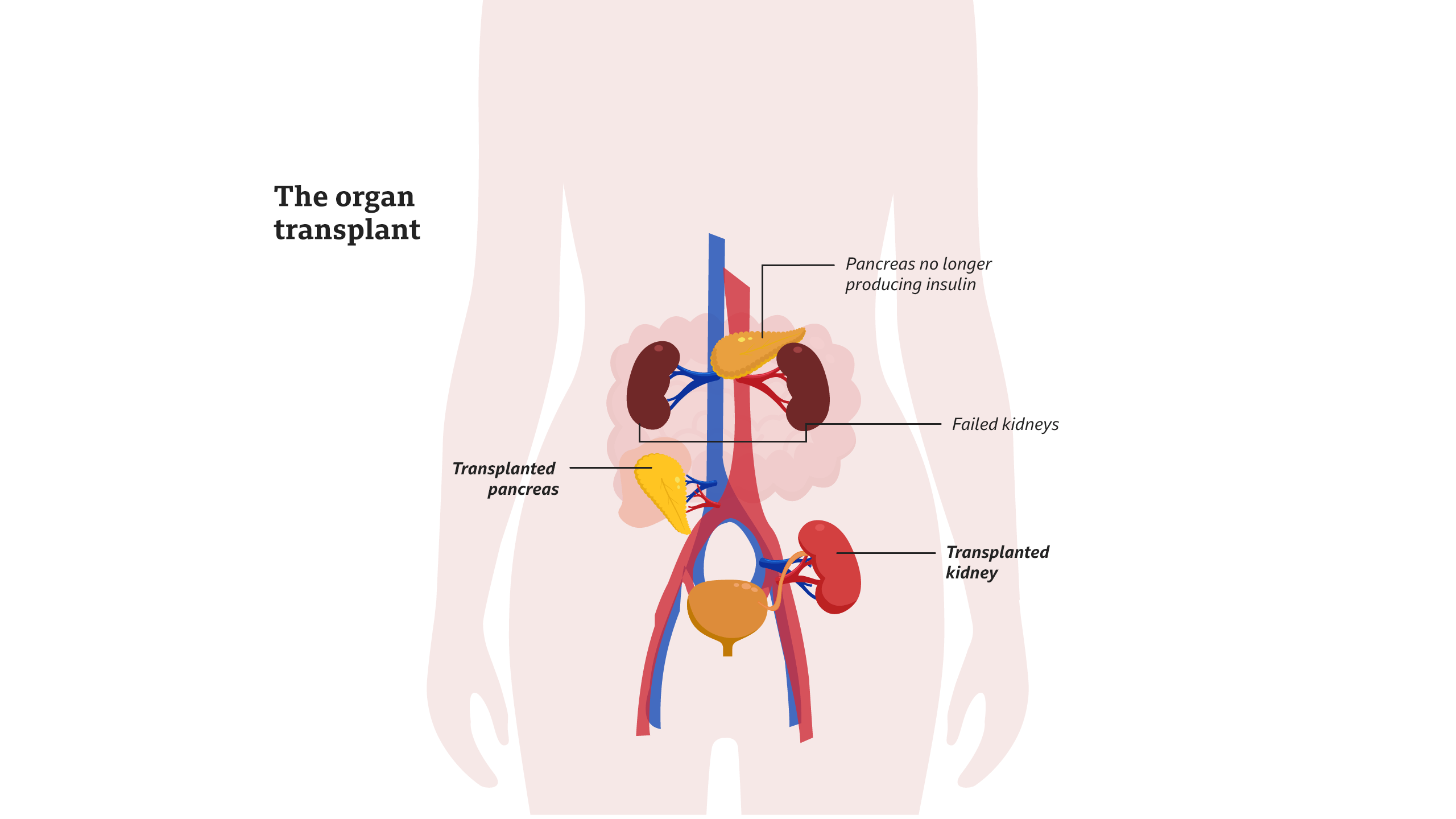 Diagram reveal: Transplanted pancreas and kidney revealed.
