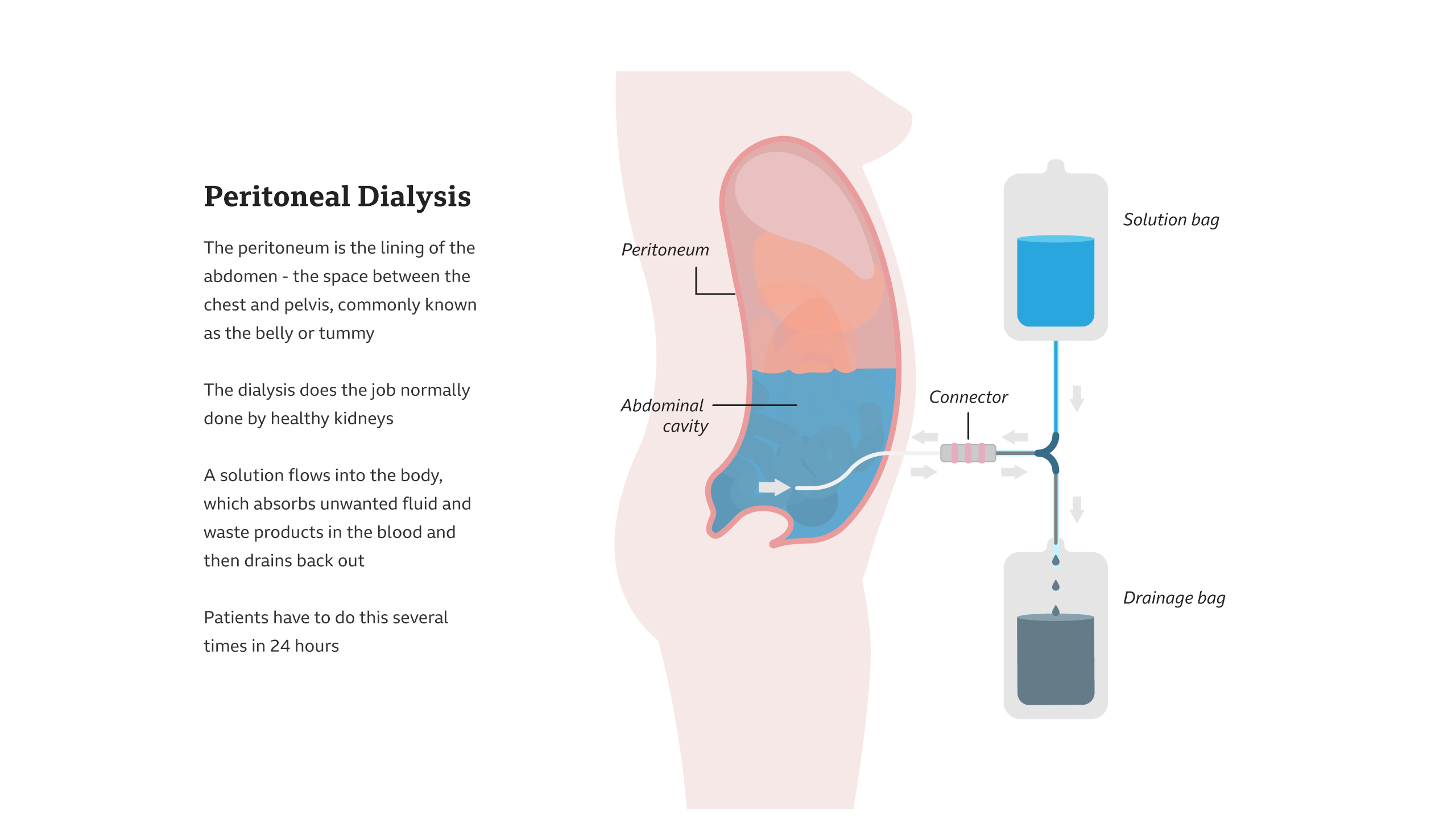 A solution flows into the body, which absorbs unwanted fluid and waste products in the blood and then drains back out. Patients have to do this several times in 24 hours.