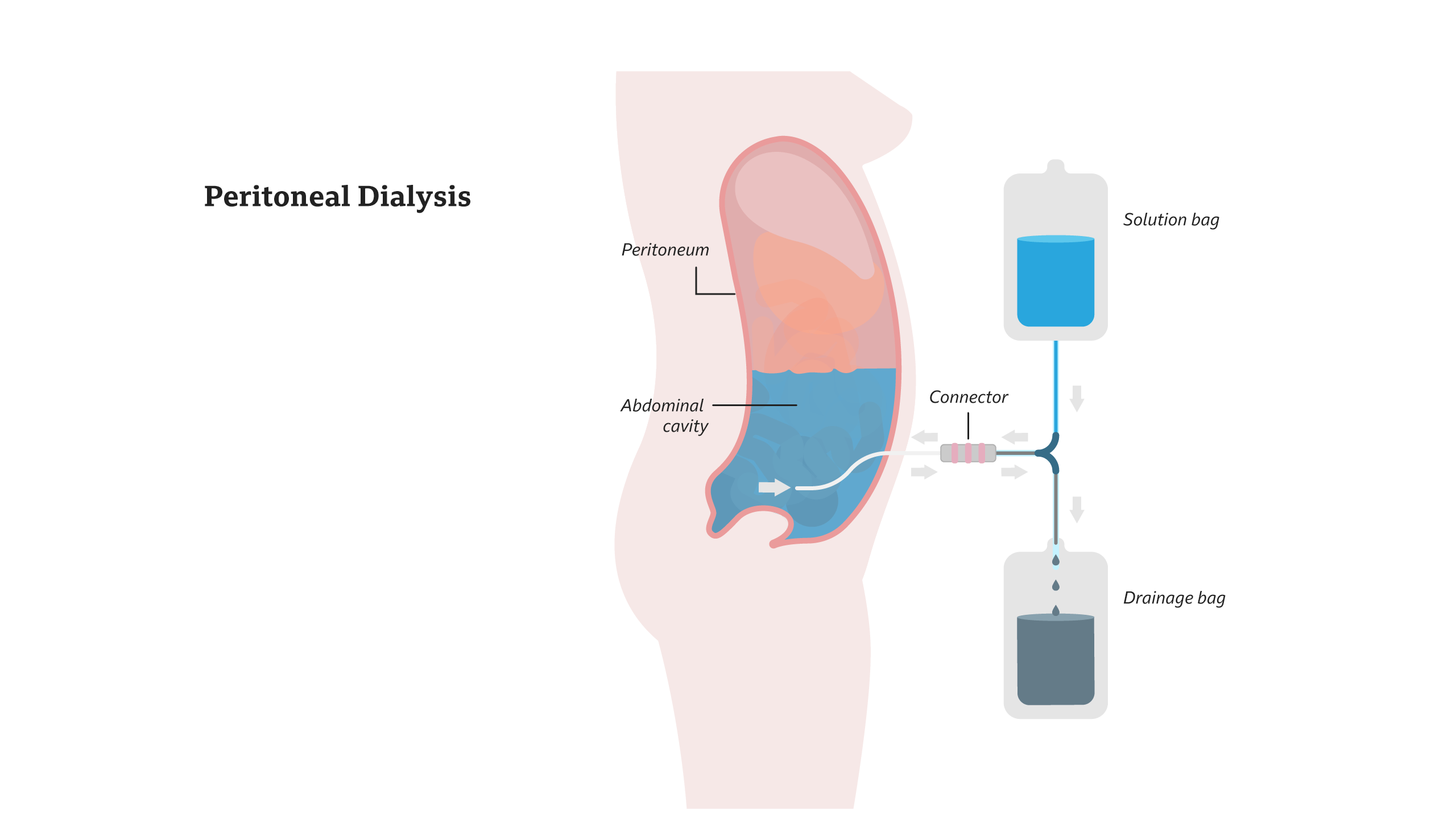 Diagram: Peritoneal Dialysis