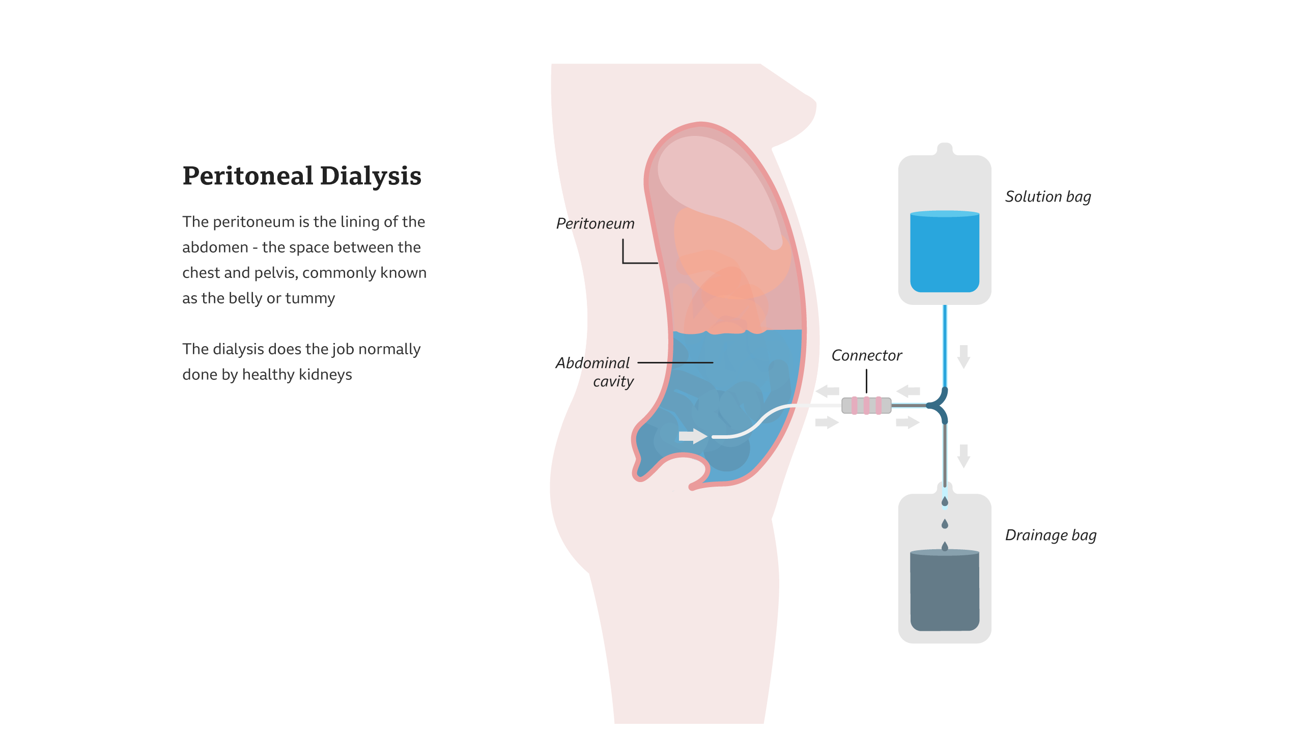 The peritoneum is the lining of the abdomen - the space between the chest and the pelvis, commonly known as the belly or tummy. The dialysis does the job normally done by healthy kidneys.