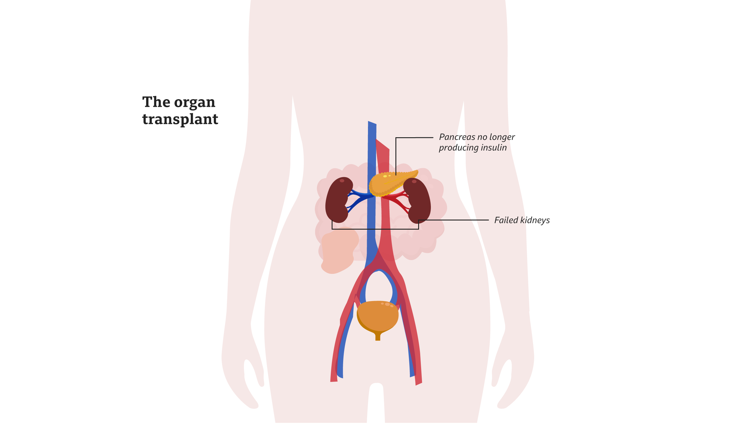 Diagram: The organ transplant. Pancreas no longer produces insulin. Kidneys have failed. 