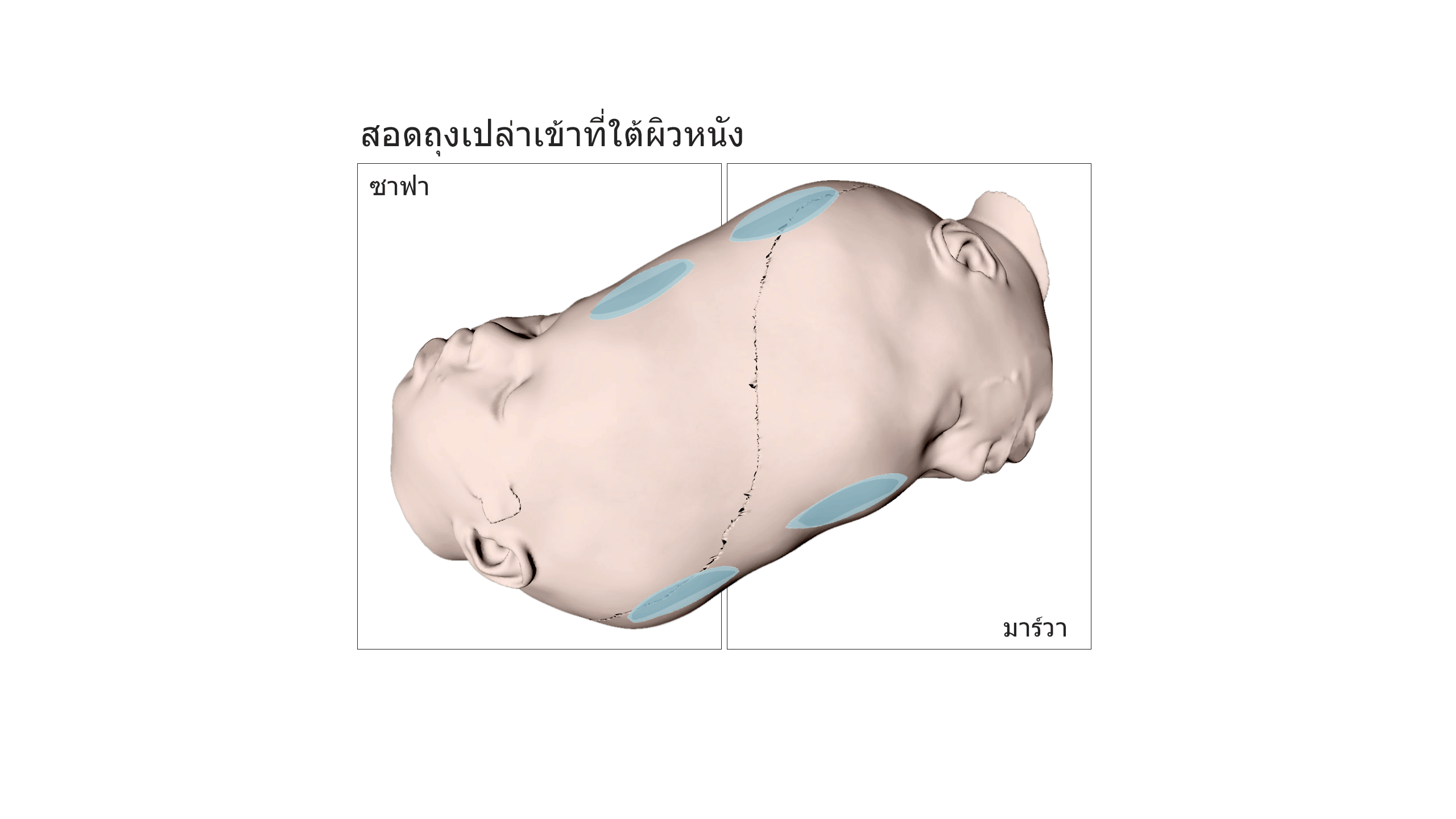 Empty sacks inserted