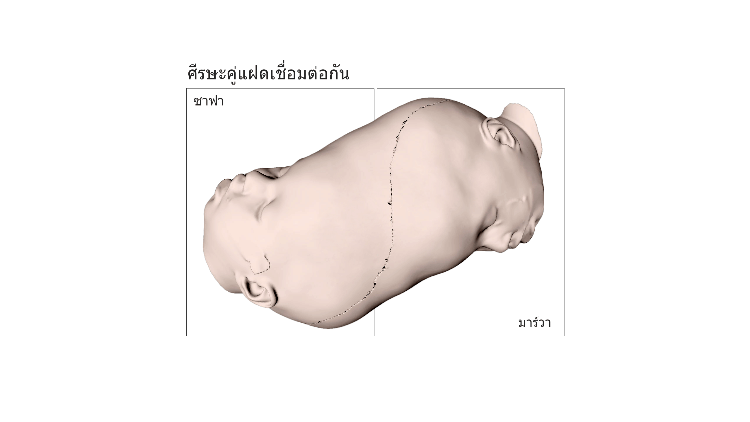 ศีรษะคู่แฝดเชื่อมต่อกัน 