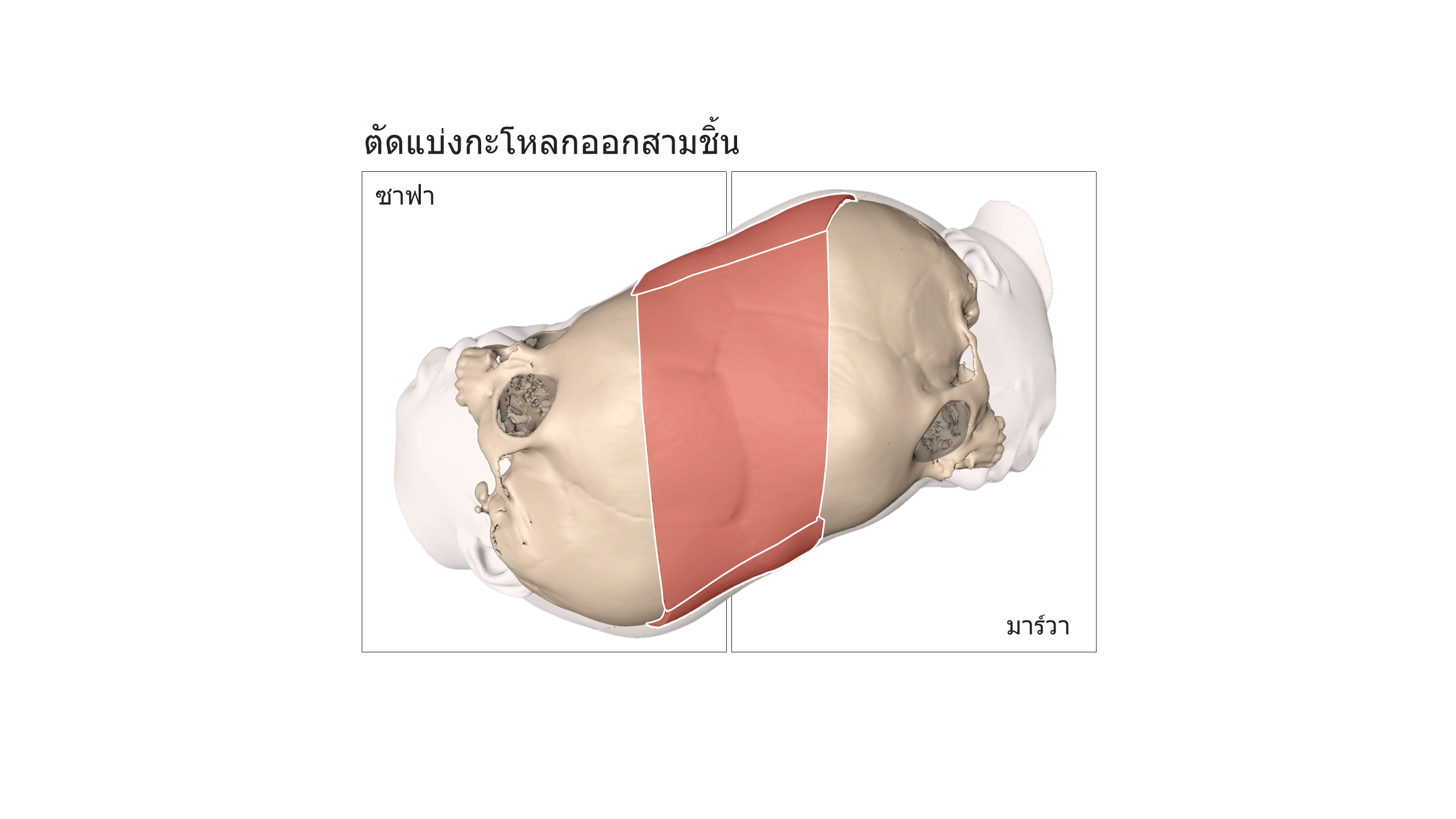 ตัดแบ่งกะโหลกออกสามชิ้น