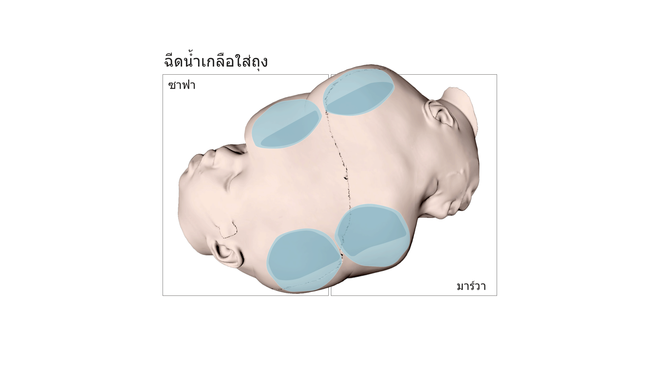 Sacks filled with saline