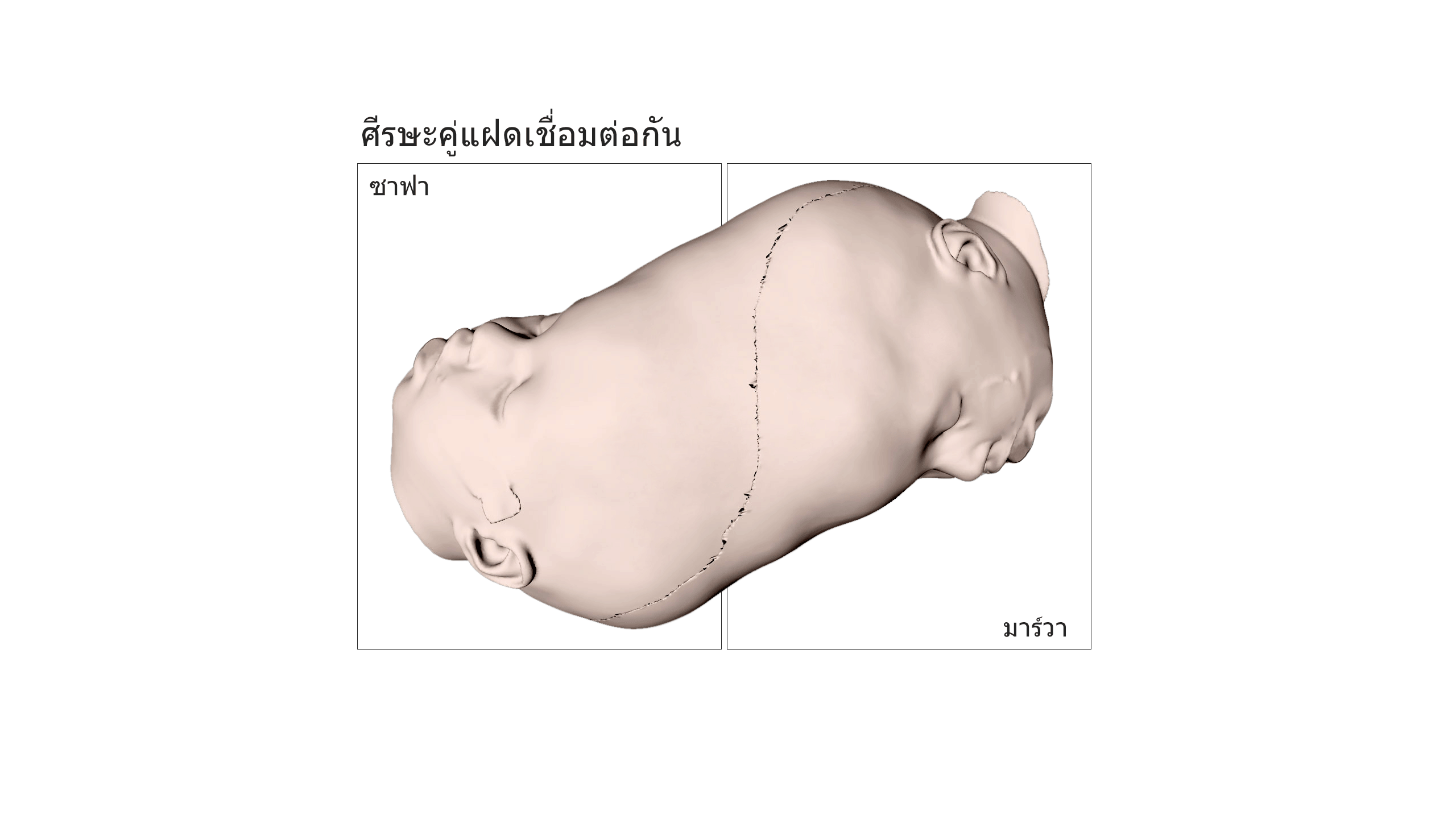 Twins' connected heads