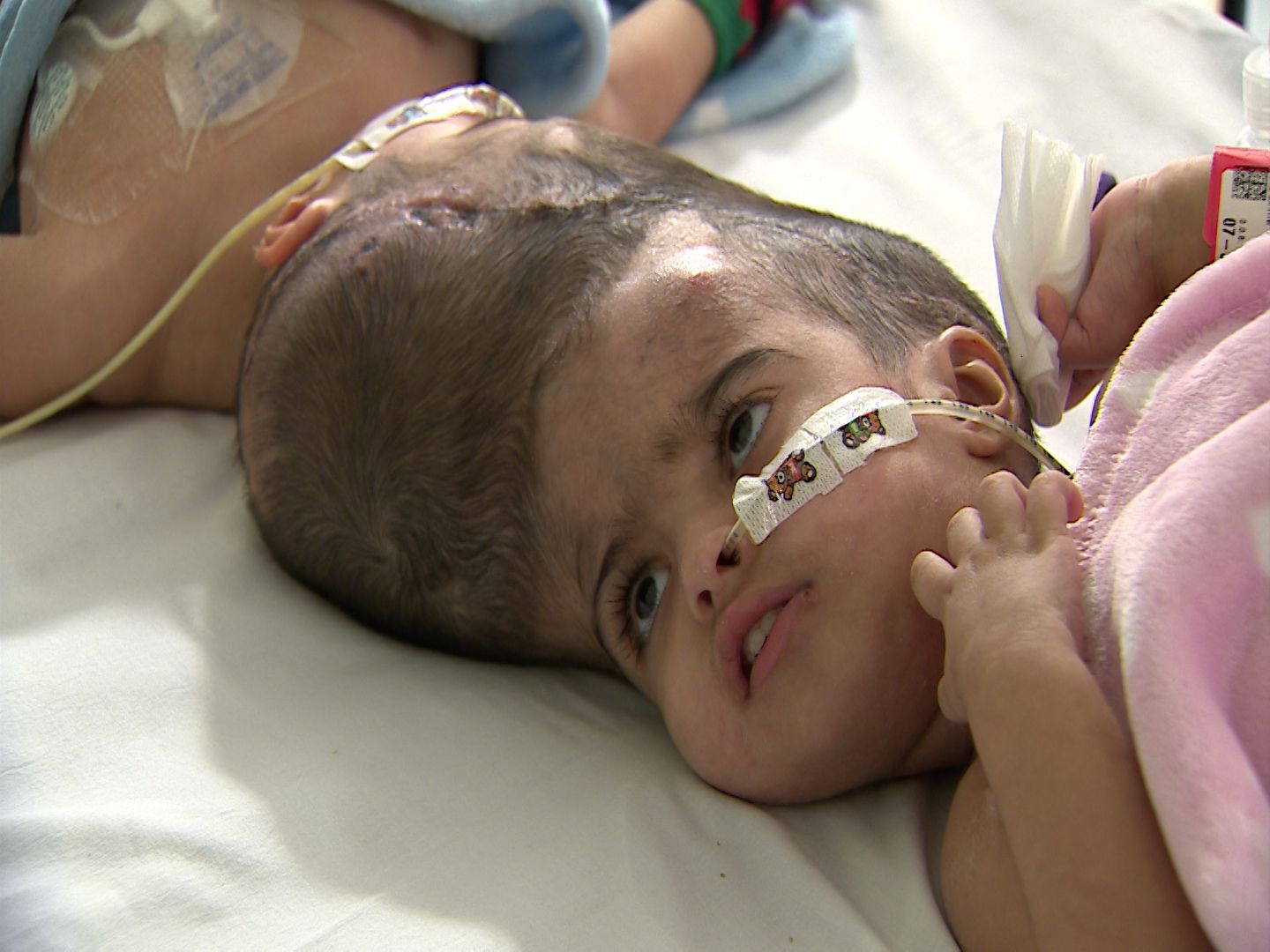 Safa and Marwa lie on a hospital bed