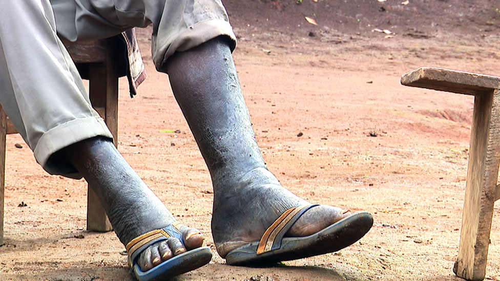 A leg affected by elephantiasis
