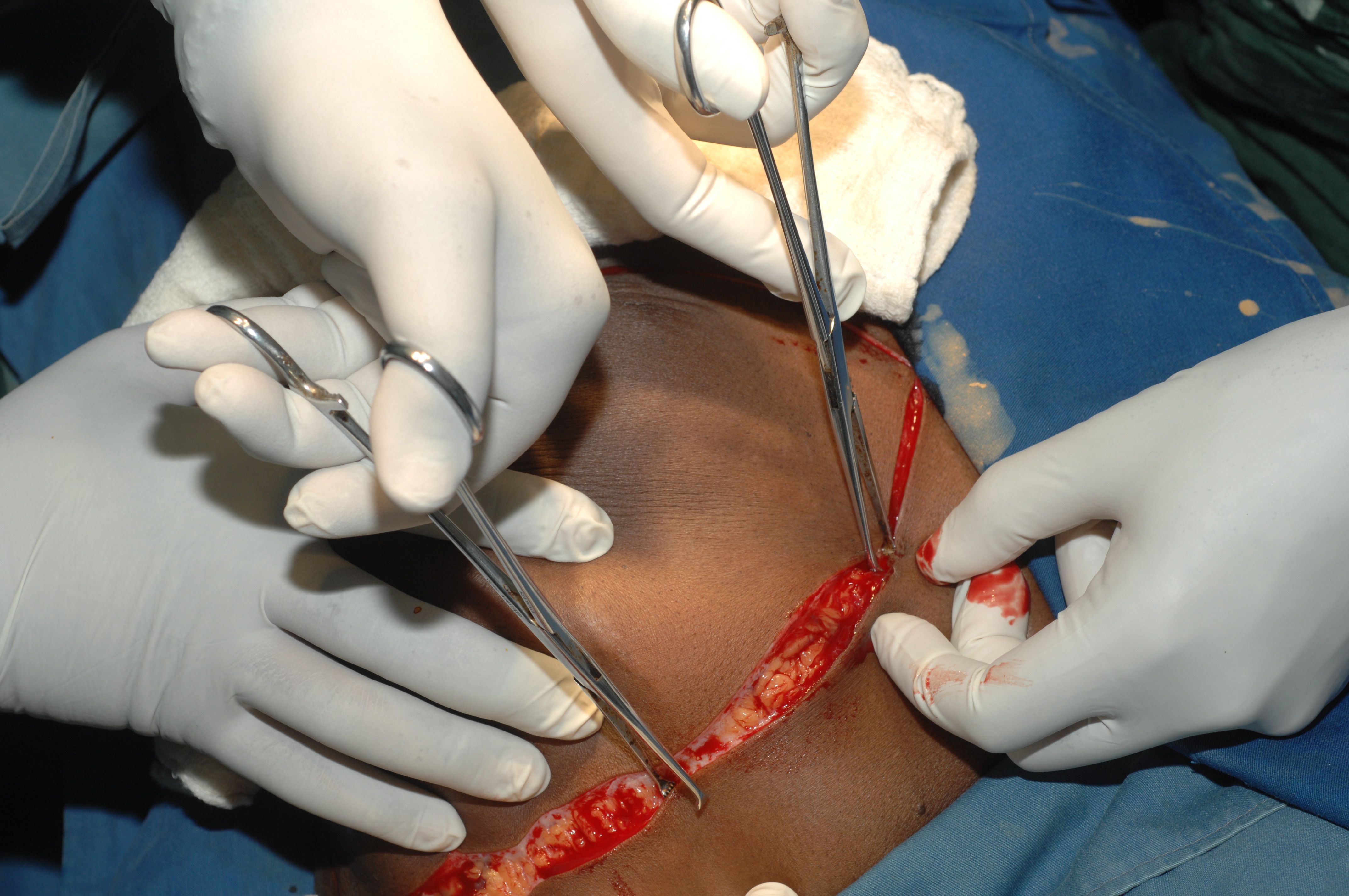 Surgeon creating incision line on left breast