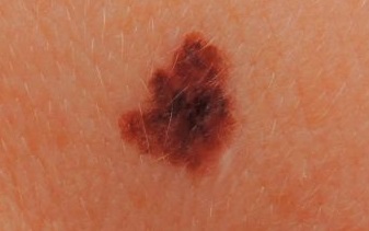 Superficial spreading melanoma