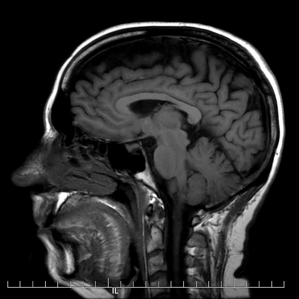 Image from one of Caroline Wyatt&#39;s brain scans
