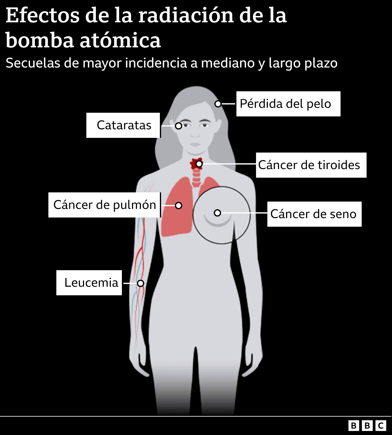 Infografía de los efectos a medio y largo plazo de la radiación: cáncer de pecho, de pulmón, de tiroides; caída de pelo; cataratas.