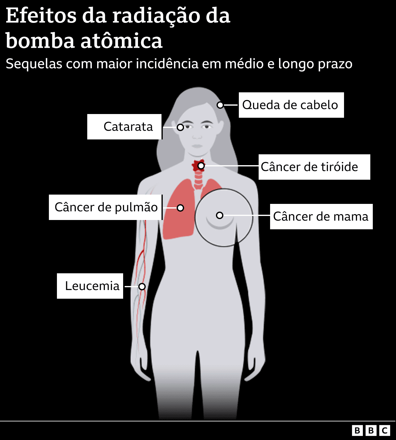 Infográfico mostrando os efeitos de médio e longo prazo da radiação: câncer de mama, câncer de pulmão, câncer de tireoide; queda de cabelo; catarata.