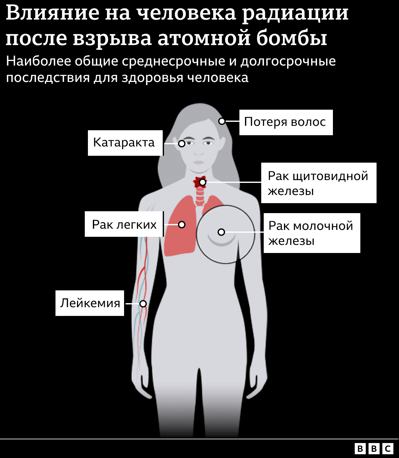 Инфографика, показывающая средне- и долгосрочные последствия радиации: рак груди, рак легких, рак щитовидной железы; выпадение волос; катаракта.