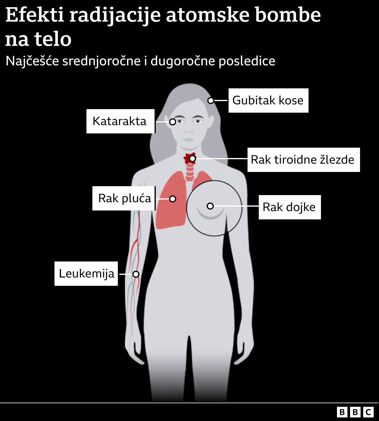 Infografika srednjoročnih i dugoročnih posledica zračenja: rak dojke, rak pluća, rak štitne žlezde; gubitak kose; katarakta.