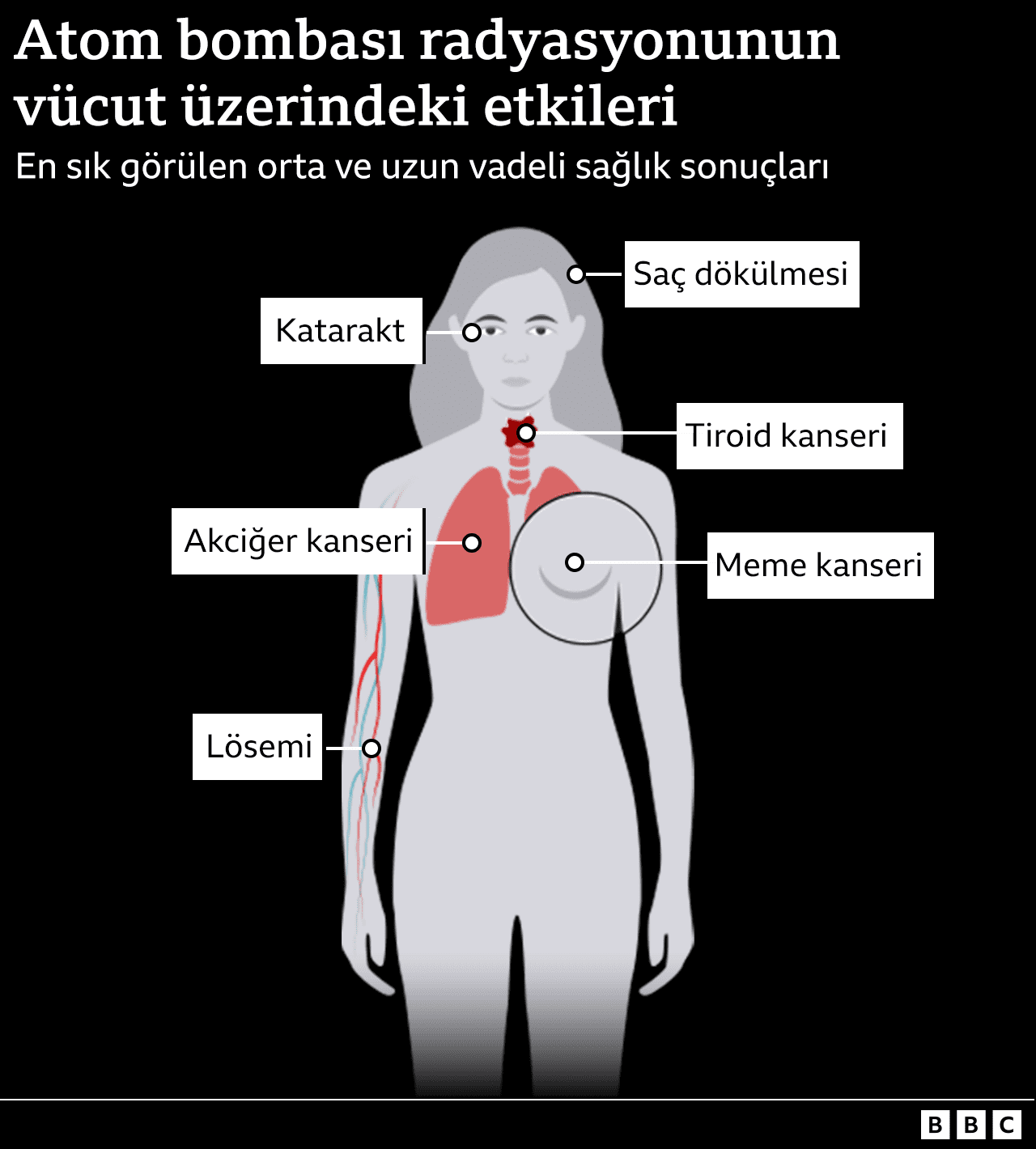 Orta ve uzun vadeli radyasyon etkilerini (meme kanseri, akciğer kanseri, tiroit kanseri; saç dökülmesi; katarakt) gösteren infografik.