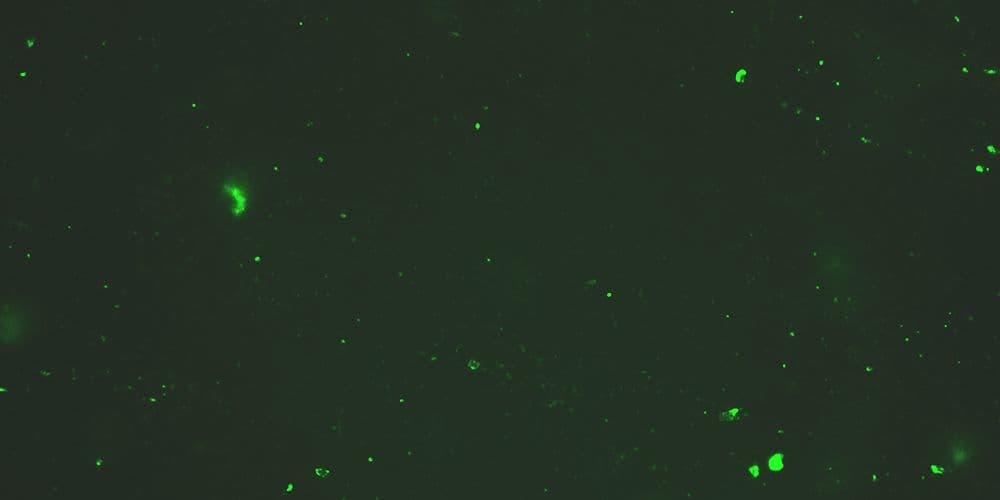 Vrlo malo mikro-ugrušaka obojenih u zelenu fluorescentnu boju u krvi pacijenta sa dugotrajnim kovidom.