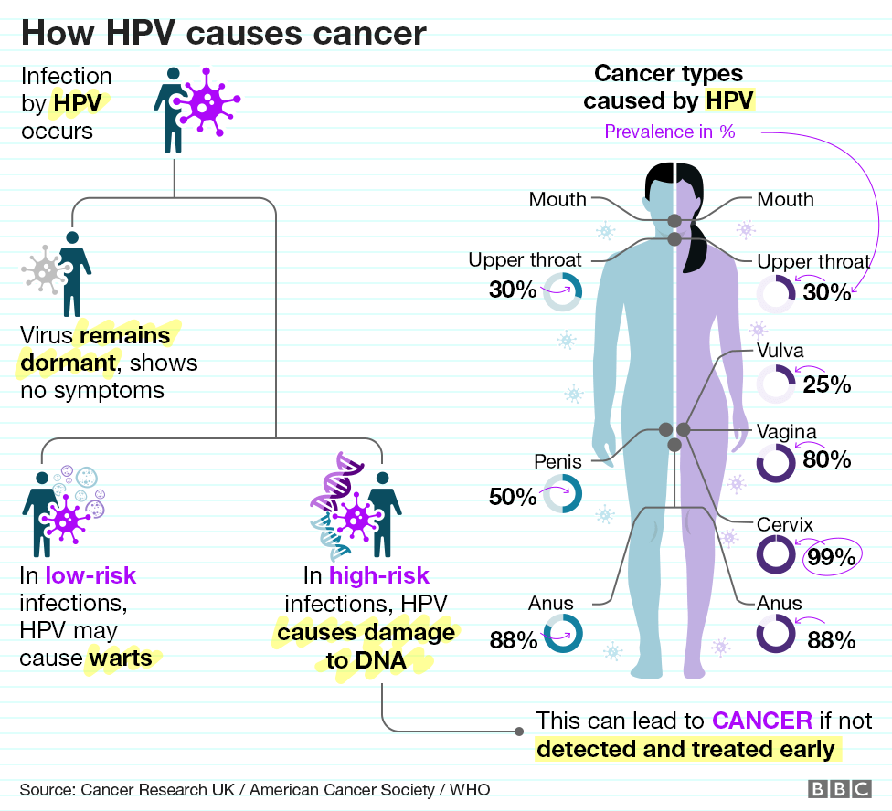 There is an infographic showing how HPV causes cancer. When HPV infection occurs, the virus may remain dormant or cause warts or damage DNA hence causing cancer