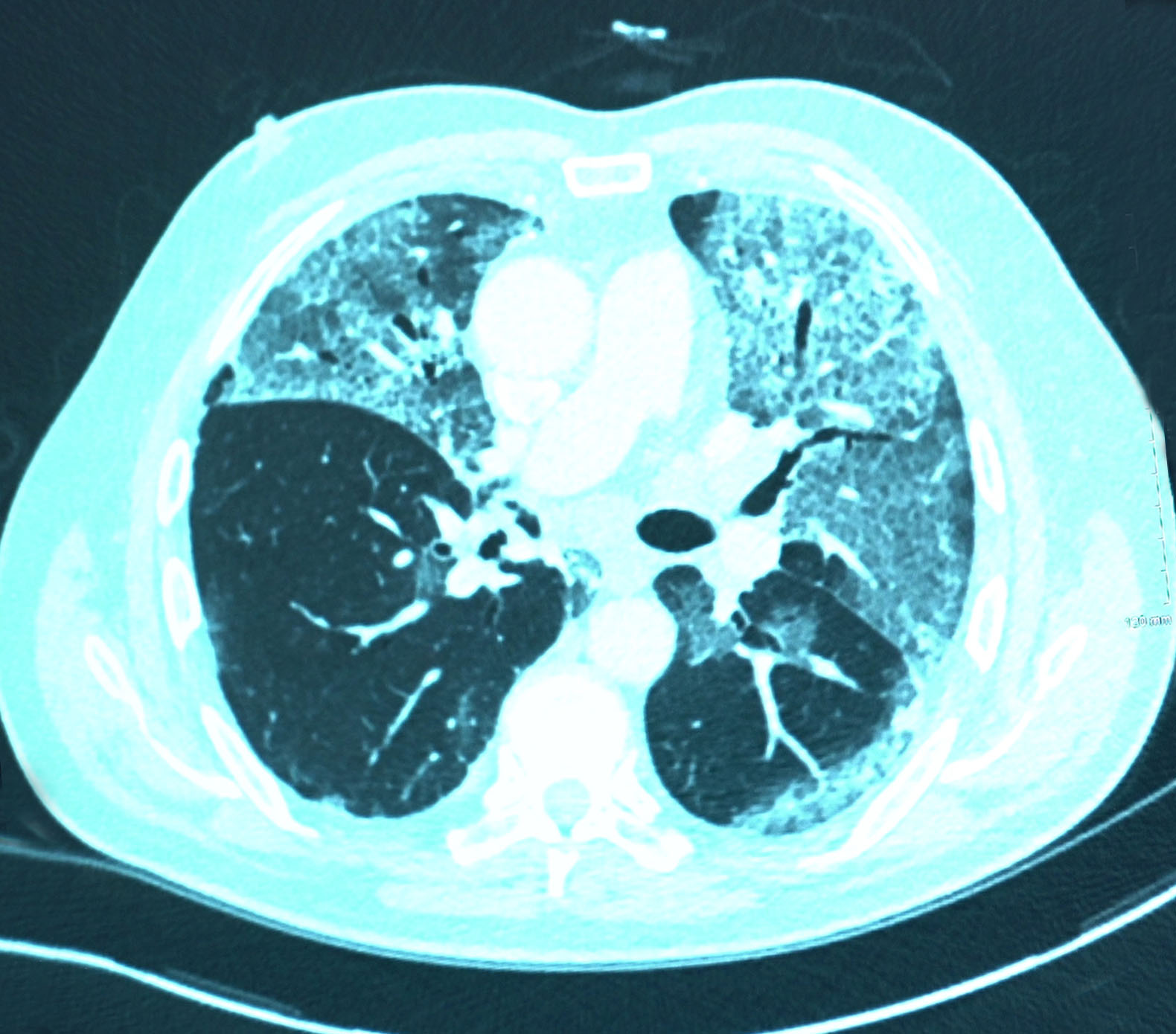 Tony's lungs after Covid-19, with scarring